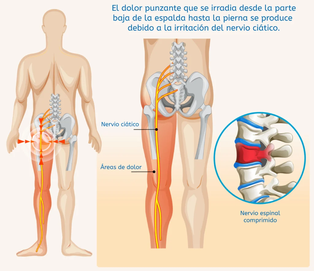 dolor nervio sciatic